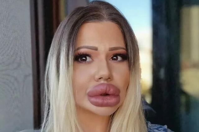 妹子丰唇27次，香肠嘴已经不足以形容了！疯狂到一天打6针