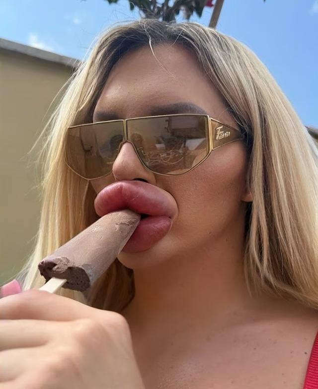 妹子丰唇27次，香肠嘴已经不足以形容了！疯狂到一天打6针