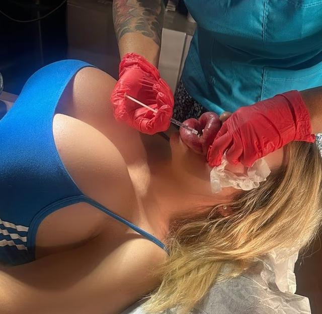 妹子丰唇27次，香肠嘴已经不足以形容了！疯狂到一天打6针